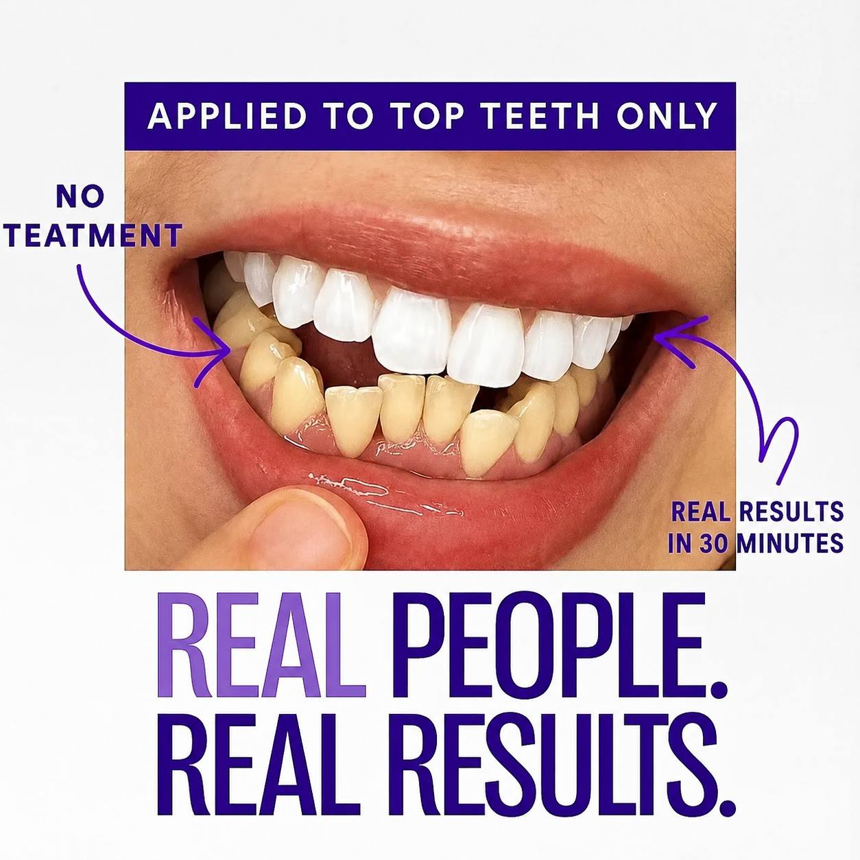 Pure'Aera Purple Teeth Whitening Strips™